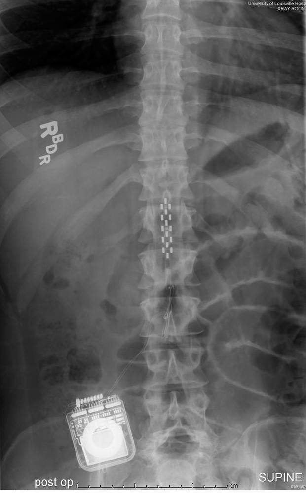 11OLSpinalStimulationXRay-1381869862172.jpg